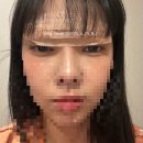 에스에이치(SH)성형외과의원 | 20대 눈썹하거상 수술 에스에이치(SH)성형외과_2026년 최신(금액포함)