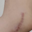 고운빔의원 | 청주 피부과, 어느 피부과전문의 흉터 치료 기록: 2년간의 여정(I)