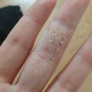 한포진, 습진, 트러블에 써보세요 / 남유네 CCP크림 솔직후기 (내돈내산)