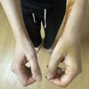 손목 분쇄 골절 수술 후기 혐짤주의
