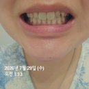 플러스덴치과기공소 | 스노우플러스 톤업 분말 치약 미백치약 내돈내산 찐 사용후기