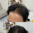 나두가 | 다산역 두피 탈모커버 나두 정수리,M자 탈모 해결 SMP 뜻