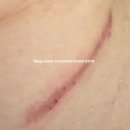 한강수병원 | 한강수병원 갑상선 암 수술 후 흉터 레이저 3회차 후기