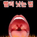 뜨거운음식 입천장 까짐 물집 염증 아픔 식도암 유발 이미지