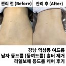 열매약국 | 강남 역삼동 여드름 남자 등드름 (등여드름) 흉터 제거 '뉴알라딘필링' 라엘보떼 후기 및 시술비용