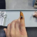 발아정형외과의원 | 철심제거_발아정형외과_내돈내산💸