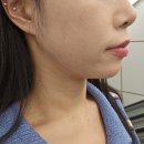 기린성형외과의원 | [이중턱 지방분해주사] 기린성형외과 갸름주사 1회차 내돈내산 리얼 후기 (전후 사진)✨️