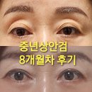논현로 1L | 서울 압구정 아몬드성형외과 눈위꺼짐 눈꺼풀처짐 심해서 중년눈 상안검수술 8개월차 찐후기 비용