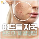 호산한의원 | 수험생 여드름 자국 치료는? 선정릉역 한의원에서! (+후기영상)