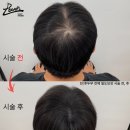 레이븐스칼프
