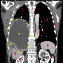 암(癌, Cancer) 혹은 악성종양 이미지