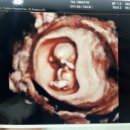 율산부인과의원 | 임신10주차 13주차 초음파사진 입체초음파 1차기형아검사 원주율산부인과 후기