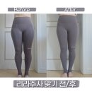 리라 | 삼성역피부과 허벅지지방분해주사 후기 리라주사 효과 진짜 있네