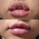 커피악마 | 신사역 입꼬리필러 입술 악마입꼬리 붓기 멍 일주일~한달차 후기
