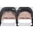 뷰티뷰 | 헤어라인교정/헤어라인 교정]드디어 큰 얼굴 스트레스에서 벗어났다 ! 뷰티뷰 헤어라인 내돈내산 찐후기