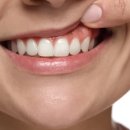 하이교정치과기공소 | 홍대교정치과 인비절라인 기간보다 더 중요한 것 <필독>