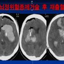 뇌출혈 - 뇌정위적혈종제거술 05 (Bad) 이미지