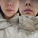 인천고주파 | 인천 송도 피부과 텐써마 300샷 후기｜고주파리프팅으로 느낀 고현정리프팅 변화