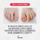 나도손톱 레푸스 개봉점 이미지