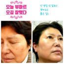 아산 뷰마르 검버섯 제거 피부관리 내돈내산 후기