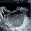 생동한의원 | 자궁내막증, 비잔 복용시작