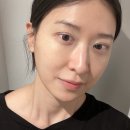 (주)에니웨이 - 13779 | 인라인으로 짝눈교정 자연유착 매몰 쌍꺼풀수술후기 약 2년차 후기 (쌍수붓기기간 가격)