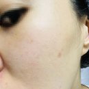 새율촌제일의원 | 비아프 커스텀 레이저 후기 비아프의원 꾸준히 다녀봤어요