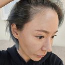 걸&보이헤어라인 | 남자 여자 M자 탈모 헤어라인 비절개 모발이식 수술 전후 1년 후기