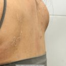 이아소에스테틱 | 고양피부관리 이아소에스테틱 등드름필링 예신 등드름 비포애프터 후기