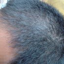 탈모봉독요법에 대한 간단한 설명입니다.~이곳은 (승용차)는 서울외곽 순환고속도로에서 평촌 ic 로 나오면 5분 거리...(지하철)은 평 이미지