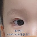 오안과의원 | [육아일기] 다래끼 콩다래끼 두돌아기 안과방문 후기