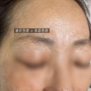 971 | 중랑구 눈썹 실패없는 잔흔커버 후기