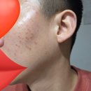 별내한의원 | 별내피부과 새살침 한의원 내돈내산 6회차 리뷰
