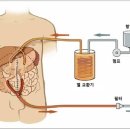 복강내 온열 항암화학요법 Hyperthermic Intraperitoneal Chemotherapy (HIPEC)- 연대 이미지