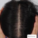 맥스웰피부과의원 | 맥스웰 강남 탈모치료 12회차 후기 + 전후사진