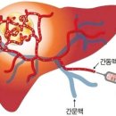 폐암, 유방암, 대장암, 담도암, 췌장암, 위암, 난소암, 자궁암, 신장암의 혈관 내 치료술 (IVR / TACE) 이미지