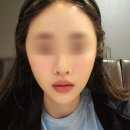 주식회사 동진생활건강 | 강남피부과 엘라비에리투오 5cc 시술후기 | 다운타임과 주기별 변화