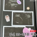 [임신일기] 임신 35~37주 기록, 출산 전 검사와 태동검사, 37주5일 갑자기 응급제왕하다! (출산가방...