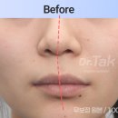닥터탁성형외과의원 | 입술 비대칭 교정, 수술vs필러. 수술후기 건강정보