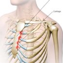 왼쪽 갈비뼈 아래 통증 유발하는 원인 10가지 이미지