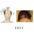 탈모[Alopecia]피부질환 이미지