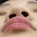 G.B.S 치과기공소 | 몽이의 성형 일기] 구순열 코 수술 상담 후기 | 병원별 비교 리뷰 &amp; 후기