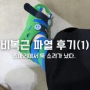 비복근 파열 후기 1탄 | 종아리에서 뚝 소리가 났다 (전조증상~ 파열 당일)