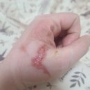 광진바른약국 | [광진구/ 군자동 약국] "화상흉터·수술흉터·여드름...겔 사용 실제 후기와 효과(전후 사진 비교!)"