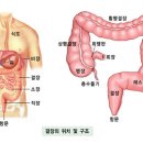 결장암 이미지