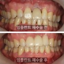 한성치과기공소 | 당일임플란트 후기, 40대 남성 &#34;타 병원 임플란트가 흔들려요 재수술 가능할까요?&#34;