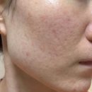 더튼튼한의원 | 리유한의원 피부 심부재생치료 가격 및 치료 과정 직접 다녀본 후기