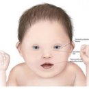 다운증후군 원인, 얼굴 특징 및 검사 (임신, 고위험군, 수명) 이미지