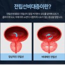 전립선 비대증 자가 치료 요법 이미지