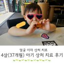 미테크성형외과의원 | 37개월 아기 얼굴 이마 열상 상처 치료 후기 (1)